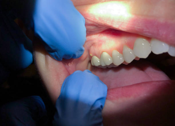 Best Emergency Root Canal Treatment in Suquamish, WA